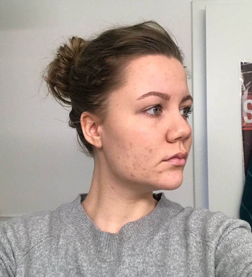 Nach der 3. Behandlung