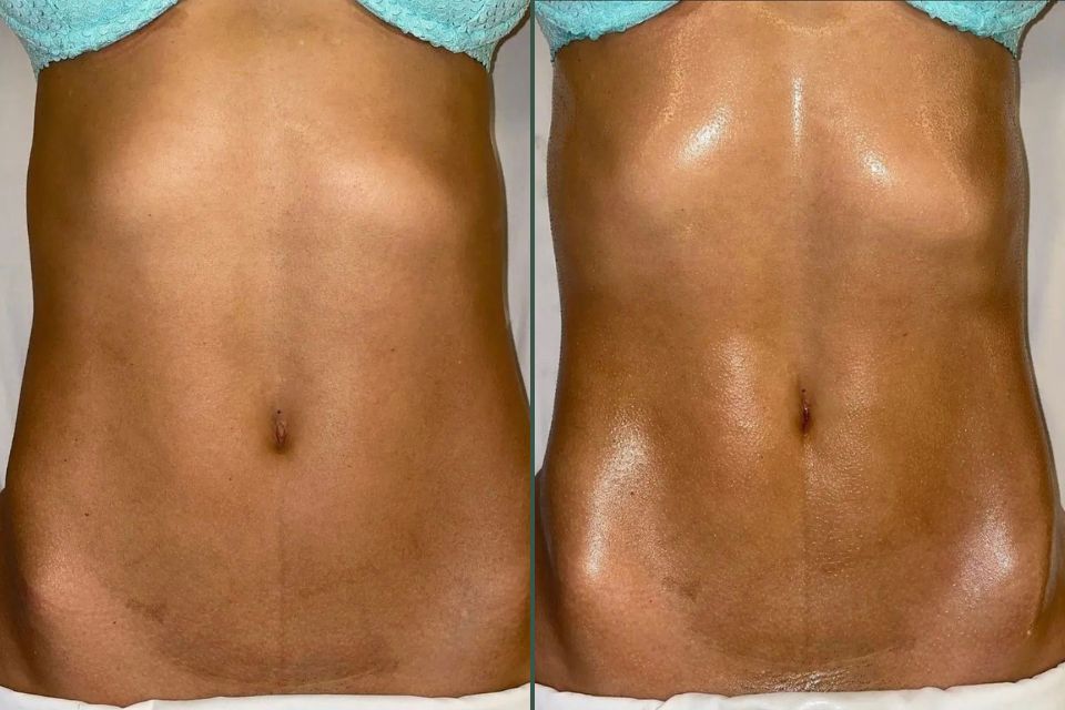 Vorher Nachher Ergebnis einer brasilianischen Lymphdrainage in München mit glatterem und sichtbar gestrafftem Bauch