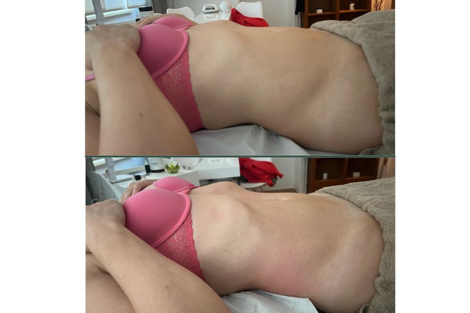Vorher Nachher Ergebnis einer brasilianischen Lymphdrainage in München mit sichtbar glatterer Haut und definierterer Körperform