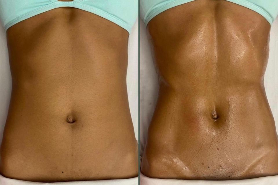 Vorher Nachher Ergebnis einer brasilianischen Lymphdrainage in München mit sichtbar strafferem und definierterem Bauchbereich