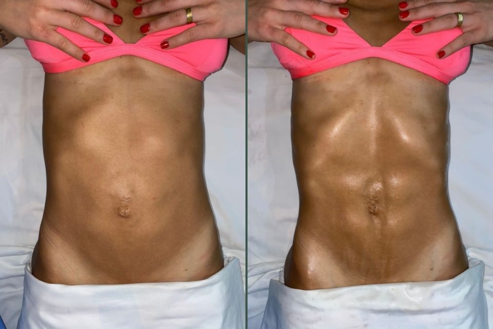 Erfahrung brasilianische Lymphdrainage – sichtbares Ergebnis in München