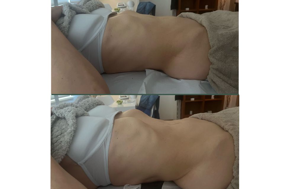 Vorher Nachher Vergleich einer brasilianischen Lymphdrainage in München mit sichtbar glatterer und definierterer seitlicher Körperkontur