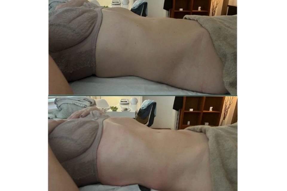 Vorher Nachher Vergleich einer brasilianischen Lymphdrainage in München mit sichtbar definierterer Taille und glatterer Körperkontur