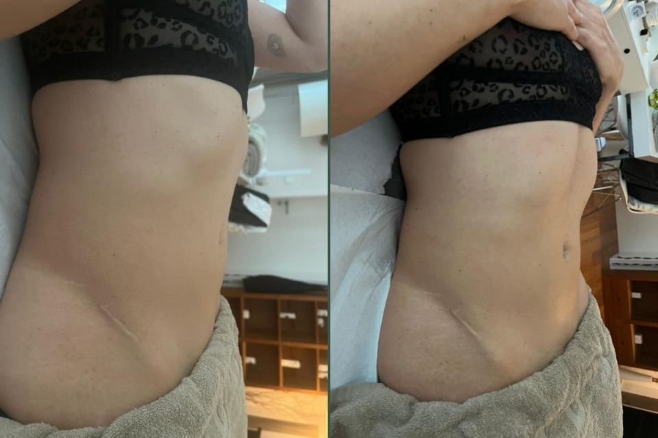 Vorher Nachher brasilianische Lymphdrainage – seitliche Veränderung